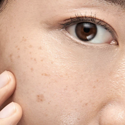 Achieving Even, Radiant Skin: Your Guide to Managing Pigmentation!